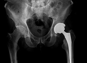 X-ray of hip with implant