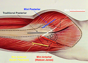 diagram showing surgical approaches