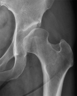 X-ray showing a dysplastic left hip with the shallow socket not covering the femoral head