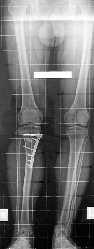 X-ray of straight leg after high tibial osteotomy