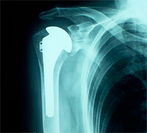 X-ray after shoulder replacement