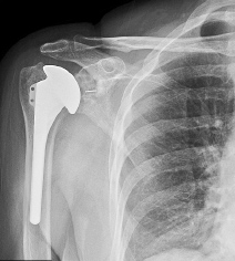 X-ray of post-op primary replacement showing a total shoulder replacement